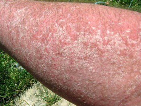 skin rash under arm #10